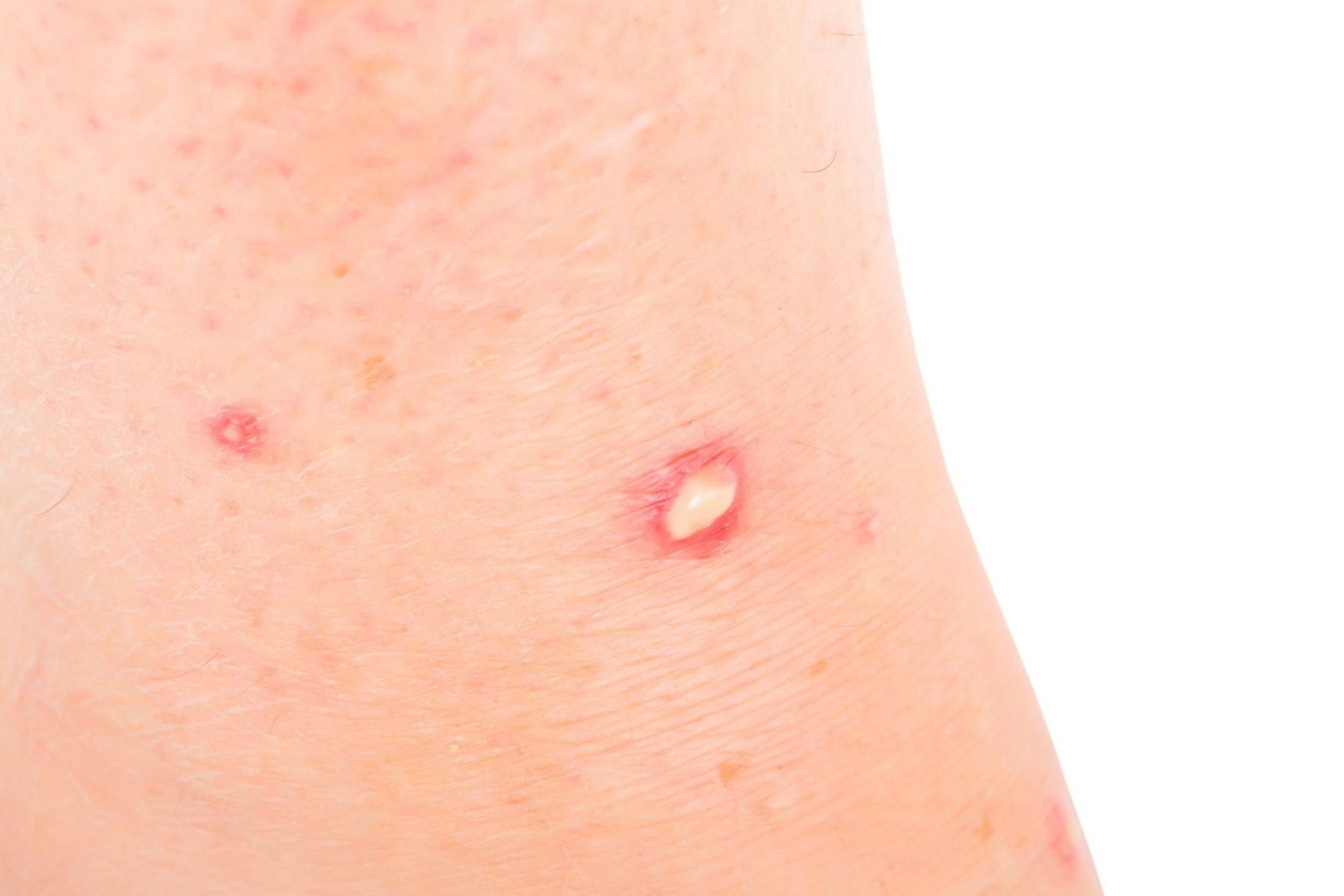 Fire Ant Bites